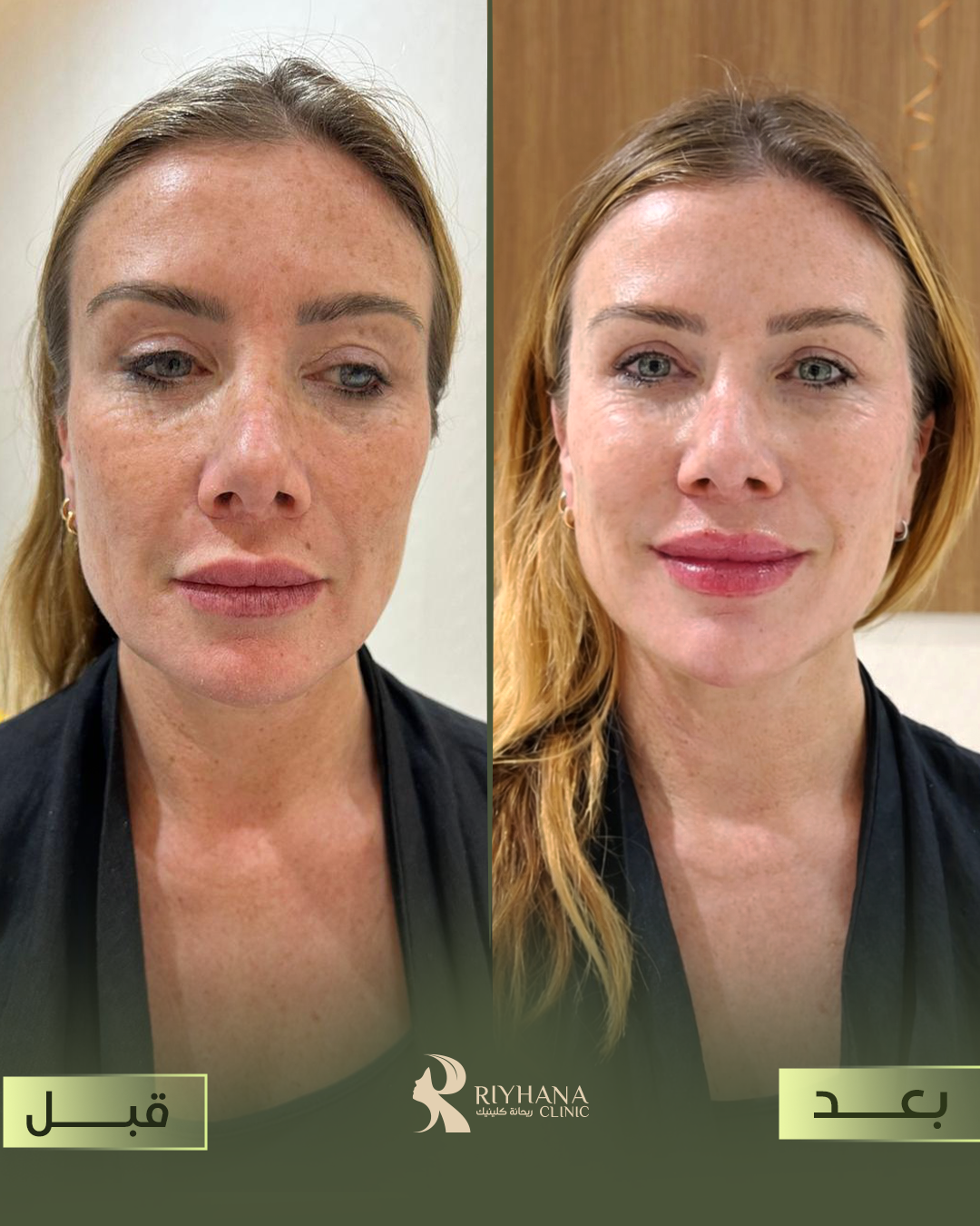 حالة فيلر - قبل وبعد