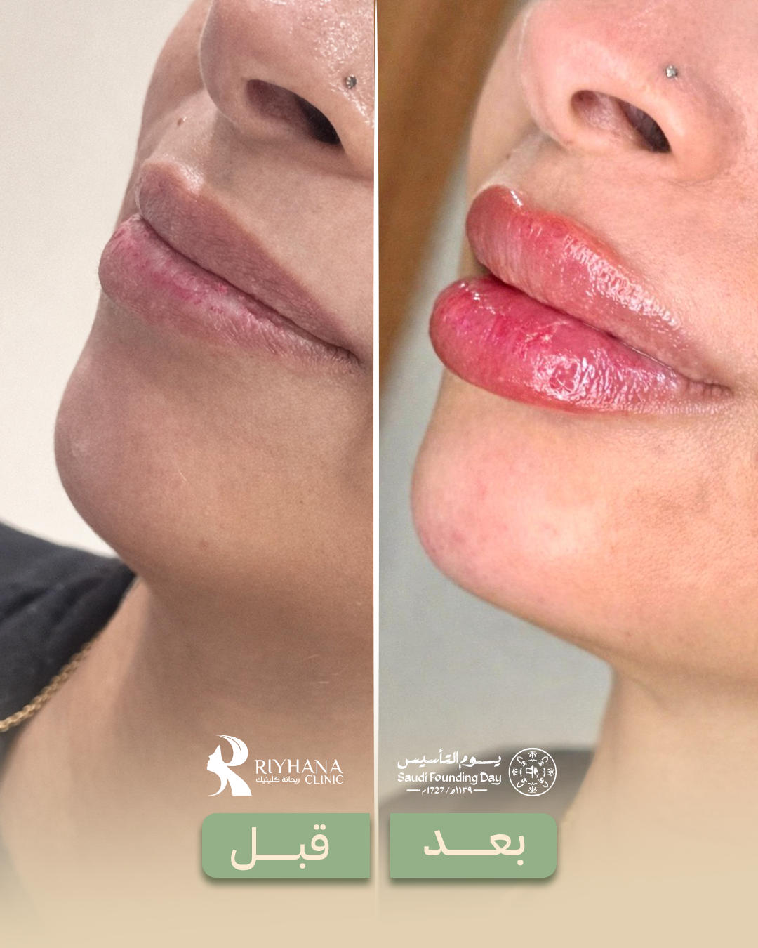 حالة فيلر - قبل وبعد