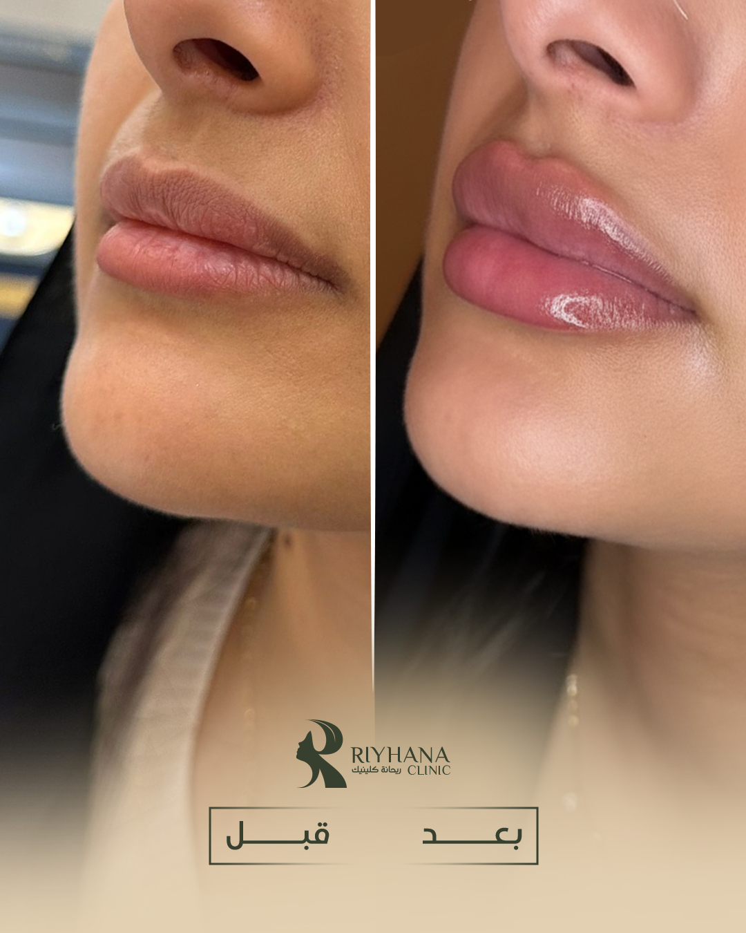 حالة فيلر شفاه - قبل وبعد