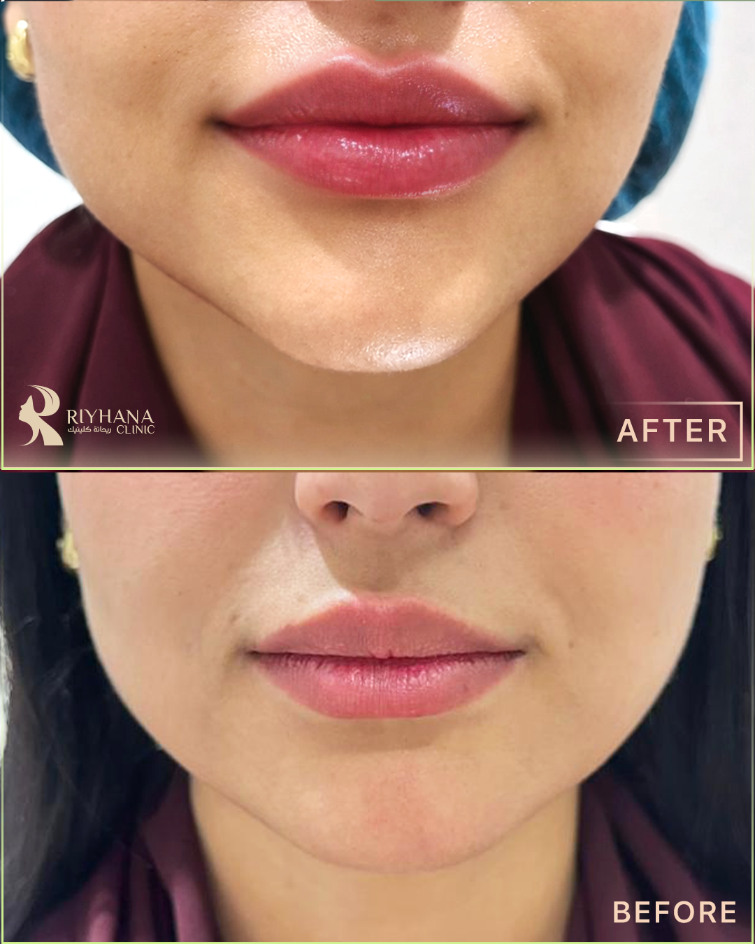 حالة فيلر - قبل وبعد