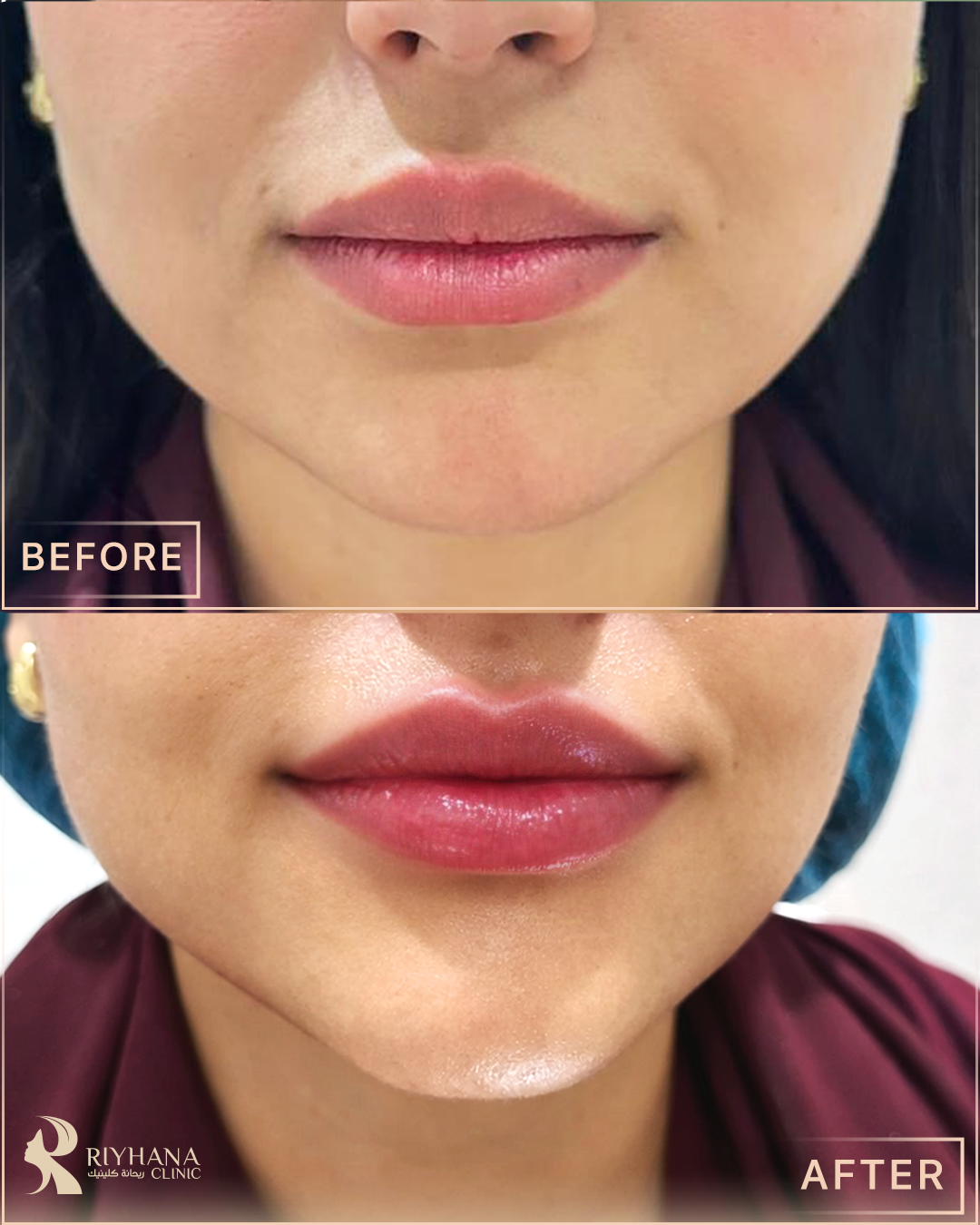 حالة تجميل - قبل وبعد