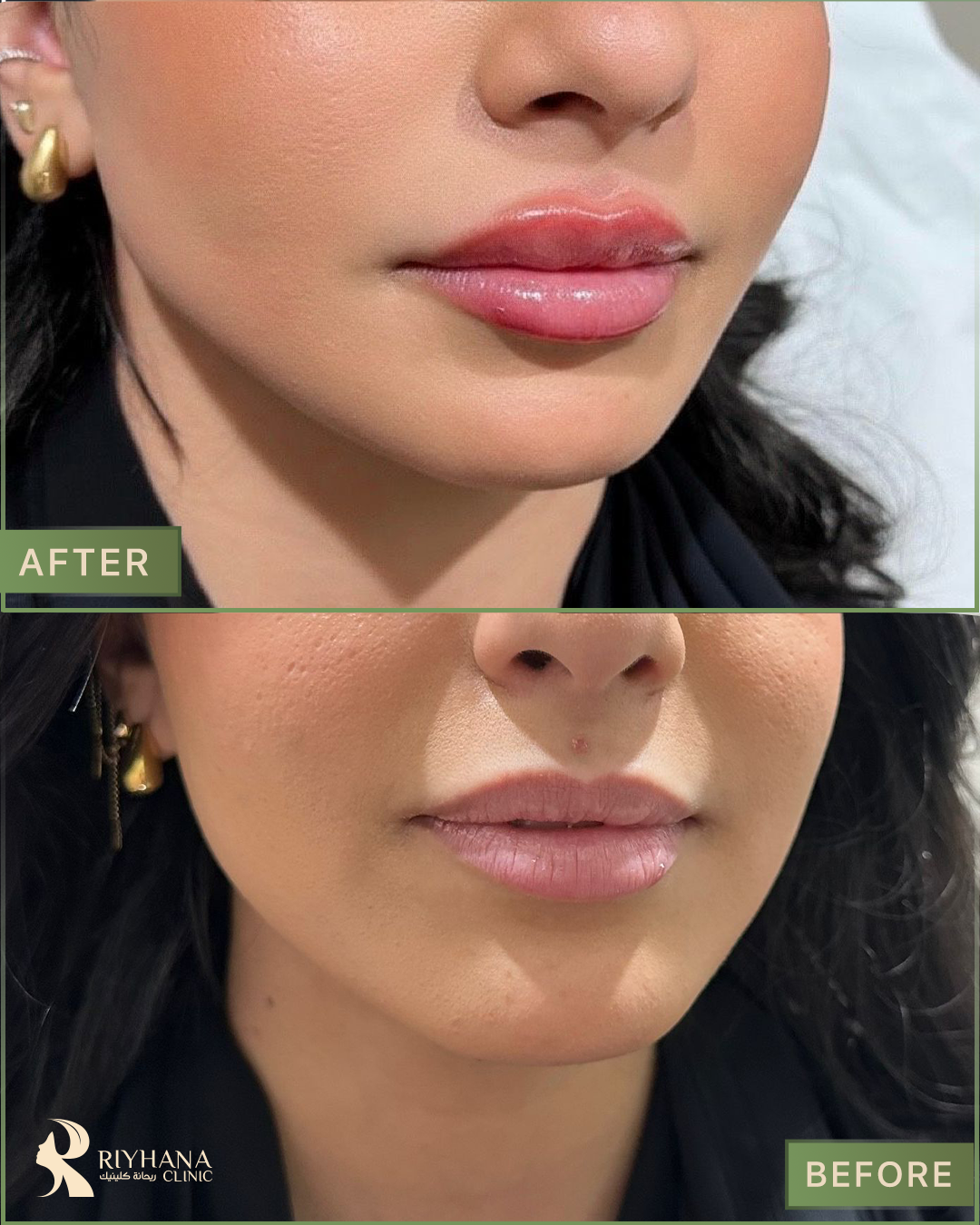 حالة فيلر - قبل وبعد