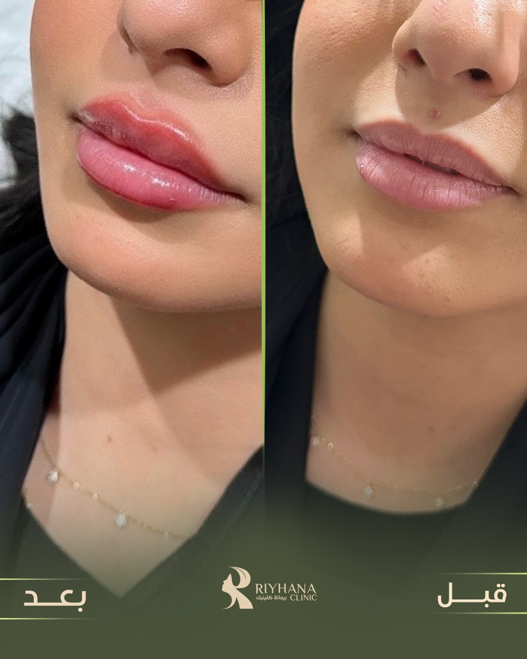 حالة تجميل شفاه - قبل وبعد