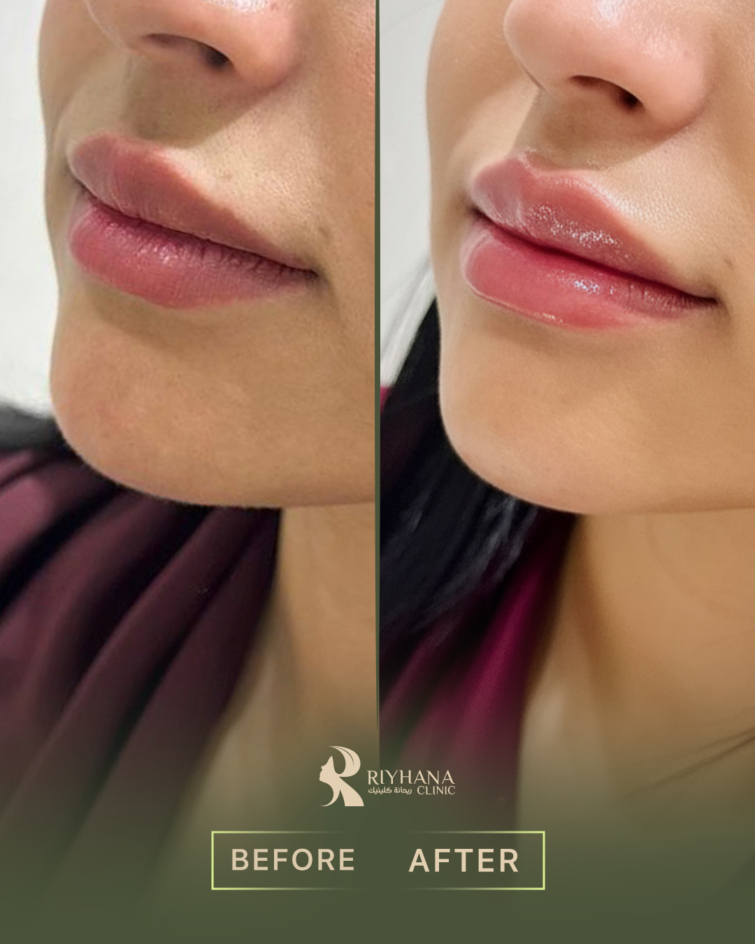 حالة فيلر - قبل وبعد